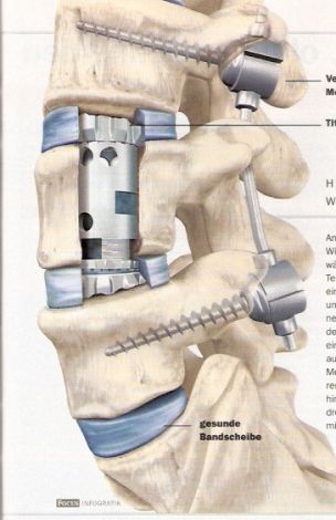 Nghiên cứu chế tạo hợp kim titan y sinh cấy ghép trong cơ thể người